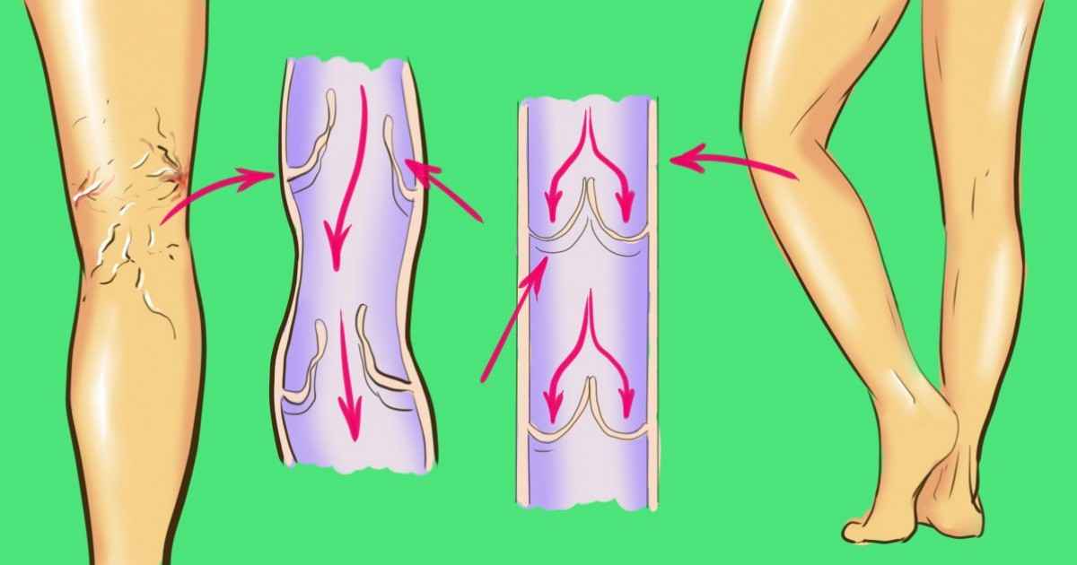 proširene vene, prevencija, zdravlje nogu, venska cirkulacija, prirodni tretmani