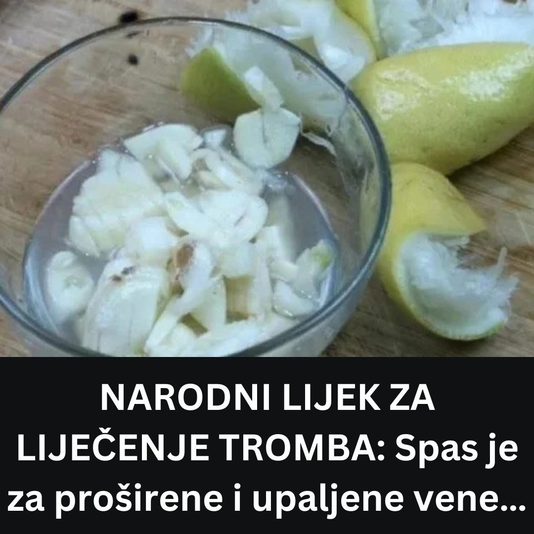 NARODNI LIJEK ZA LIJEČENJE TROMBA: Spas je za proširene i upaljene vene…