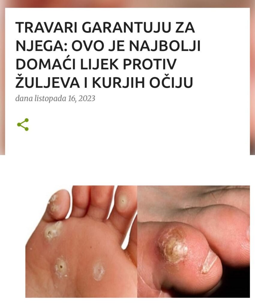 TRAVARI GARANTUJU ZA NJEGA: OVO JE NAJBOLJI DOMAĆI LIJEK PROTIV ŽULJEVA I KURJIH OČIJU