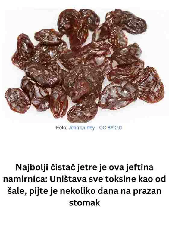 Zatim pomiješajte grožđice s 2 šalice vode i ostavite ih da se kuhaju 20 minuta. Nakon kuhanja ostavite grožđice da se namoče u vodi preko noći. Ujutro procijedite tekućinu od grožđica i popijte natašte. Nastavite s ovim postupkom nekoliko dana i vaša će jetra biti detoksicirana i spremna za obavljanje svojih osnovnih funkcija! DODATNI TEKST Održavanje stabilne razine šećera u krvi ključno je, a jetra igra vitalnu ulogu u preradi štetnih tvari s kojima se svakodnevno susrećemo, pretvarajući ih u upotrebljive oblike ili ih razgrađuju dovoljno da ih naše tijelo izbaci kao otpad. Unatoč tome, zdravlje jetre često se zanemaruje, što dovodi do konzumiranja štetnih tvari poput alkohola. Osim toga, postoji stanje poznato kao nealkoholna bolest jetre, koja može nastati zbog konzumacije slatkih proizvoda, pržene hrane, visoke razine soli i crvenog mesa. Grožđice, poput običnog grožđa, obiluju vlaknima i antioksidansima, uključujući bioflavonoide i vitamin C, koji igraju ključnu ulogu u probavi i pomažu tijelu u uklanjanju štetnih toksina i slobodnih radikala. Jeste li znali da grožđice zapravo mogu imati veći sadržaj hranjivih tvari od grožđa? Istina je. Istraživanje sa Sveučilišta Berkeley pokazuje da grožđice imaju gotovo tri puta veći antioksidativni kapacitet od crnog i bijelog grožđa, što ih svrstava u jedan od najbogatijih izvora antioksidansa dostupnih u hrani. Nadalje, proces sušenja povećava koncentraciju hranjivih tvari u voću. Istraživanja su pokazala da namakanje ove hrane bogate hranjivim tvarima u vodi ima značajne prednosti. Ovaj proces namakanja pretvara hranjive tvari u tekući oblik, što poboljšava njihovu stopu apsorpcije u tijelu i podiže razinu antioksidansa. Konzumacija vode s grožđicama pojačava učinke grožđica na čišćenje jetre, omogućujući im da se brzo kreću kroz probavni sustav, dok je bogata antioksidansima koji pomažu u eliminaciji toksina. Započnite temeljitim čišćenjem 150 grama grožđica. Zatim pomiješajte grožđice s 2 šalice vode i ostavite ih da se kuhaju 20 minuta. Nakon kuhanja ostavite grožđice da se namoče u vodi preko noći. Ujutro procijedite vodu od grožđica i popijte natašte. Nastavite s ovom rutinom nekoliko dana i vaša će jetra biti detoksicirana i spremna za obavljanje svojih osnovnih funkcija.