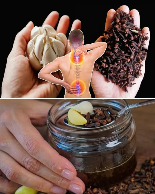 🌸 Karanfilić Sadrži eugenol, spoj koji djeluje protivupalno, antibakterijski i analgetski. Pomaže kod bolova u mišićima i zglobovima, podstiče cirkulaciju i ublažava osjećaj težine u tijelu. 🧪 Kako pripremiti ovaj prirodni lijek Sastojci: 3–4 čehna bijelog luka 1 kašika sirovog meda 5–6 karanfilića Priprema: Zgnječite bijeli luk i ostavite da odstoji 10 minuta. Pomiješajte ga s medom i karanfilićima u staklenoj tegli, zatvorite i ostavite 24 sata prije upotrebe. Primjena: Za imunitet – 1 kašičica svako jutro na prazan stomak. Za bolne zglobove – lagano umasirajte mješavinu ili procijeđeno ulje u kožu 2–3 puta dnevno. Za probavu i grlo – pomiješajte s toplom vodom i pijte kao čaj. 💚 Prirodno, efikasno i bez hemikalija! Ova jednostavna mješavina pomaže tijelu da se oporavi, smanji bolove i povrati energiju već nakon nekoliko dana redovne primjene. Isprobajte i osjetite snagu prirode u vlastitom domu! 🌿💪