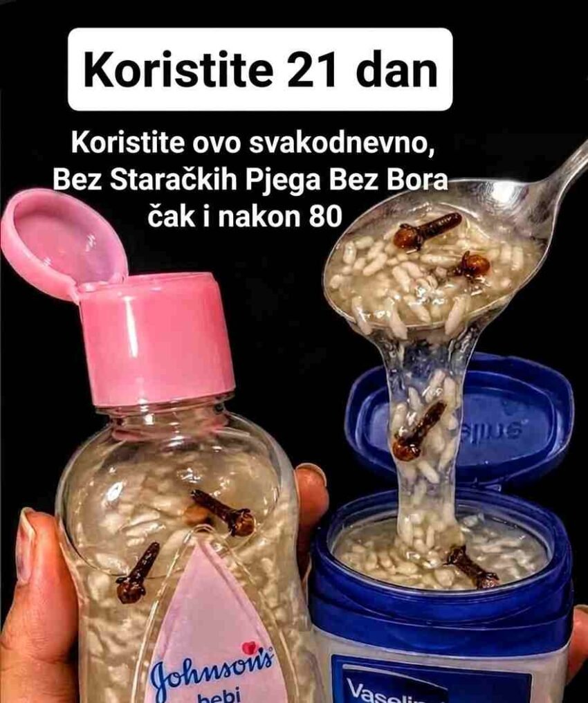 Proizvodnja kolagena prirodno opada nakon srednjih dvadesetih godina, što dovodi do pojave finih linija, opuštene kože i suhoće. Iako komercijalne kreme mogu pomoći, jednako efikasnu formulu možete napraviti kod kuće koristeći tri jednostavna sastojka: karanfilić, baby ulje i rižu. Karanfilić sadrži snažan antioksidans eugenol koji se bori protiv slobodnih radikala, riža pruža aminokiseline i peptide koji posvjetljuju i jačaju kožnu barijeru, dok baby ulje zadržava vlagu kako bi aktivni sastojci djelovali duže i dublje. Dodavanjem aloe vere, vitamina E, meda, ružine vodice, bademovog ulja i prstohvata kurkume dobijate bogatu kremu koja pruža noćno obnavljanje, sjaj i zaštitu — bez velikih troškova. Potrebni sastojci (Za oko 50 g; prilagodite količine po potrebi) 2 kašičice cijelih karanfilića (lagano zdrobljenih) – snažan antioksidans 3 kašike baby ulja bez mirisa – zadržava vlagu u koži 1 kašika fino mljevene riže – bogata peptidima za kolagen i posvjetljivanje 1 kašika svježeg aloe vera gela – smiruje i regeneriše kožu 1 kapsula vitamina E (≈ 400 IU) – štiti kožu i produžava rok trajanja 1 kašičica sirovog meda – hidratant koji privlači vlagu 1 kašičica hladno cijeđenog bademovog ulja – omekšava i hrani kožu 1 kašičica ružine vodice – balansira pH i sužava pore ¼ kašičice kurkume (po želji) – dodatni antioksidans i posvjetljivač Postupak 1. Infuzija ulja: Zagrijte baby ulje na laganoj vatri (oko 50°C). Dodajte zdrobljene karanfiliće i ostavite 20 minuta. Procijedite i ostavite da se malo ohladi. 2. Priprema riže: Pomiješajte rižin prah sa 1 kašikom tople vode dok ne dobijete glatku smjesu. 3. Pravljenje kreme: Polako dodajte ulje u smjesu riže uz stalno miješanje. Miješajte dok ne dobijete gustu, kremastu teksturu. 4. Hlađenje i dodaci: Kada se smjesa ohladi (ispod 40°C), dodajte aloe veru, med, vitamin E, bademovo ulje, ružinu vodu i kurkumu. Dobro promiješajte. 5. Čuvanje: Prebacite u čistu staklenu posudu (50 g). Čuvajte u frižideru do 2 mjeseca. Kako koristiti Test osjetljivosti: Nanesite malu količinu na unutrašnju stranu lakta i sačekajte 24 sata. Noćna rutina: Nakon čišćenja lica, nanesite malu količinu na lice i vrat. Masaža: Lagano masirajte kružnim pokretima oko 60 sekundi. Učestalost: Počnite 3 puta sedmično, zatim koristite svaku noć. Higijena: Koristite čiste ruke ili špatulu. Prednosti ove prirodne kreme Smanjuje bore i fine linije zahvaljujući antioksidansima Posvjetljuje i ujednačava ten Dubinski hidrira kožu i daje “glow” efekt Jača zaštitnu barijeru kože Smiruje crvenilo i iritacije Ostavlja kožu mekanom, sjajnom i zdravom